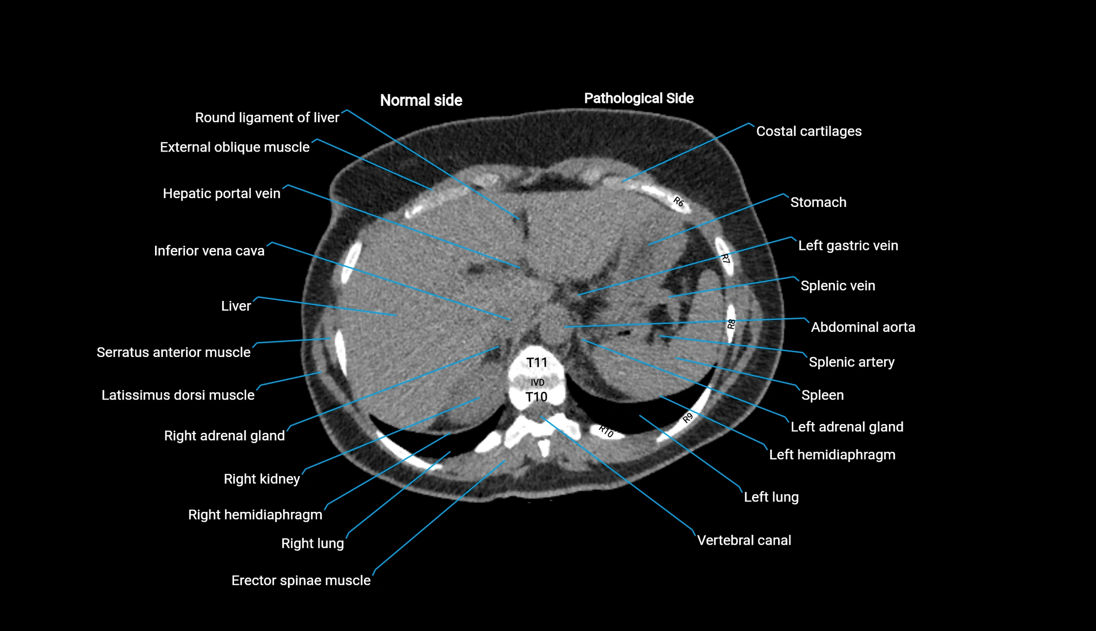 CT KUB axial cross sectional anatomy  radiology image -img-00201-00013.webp
